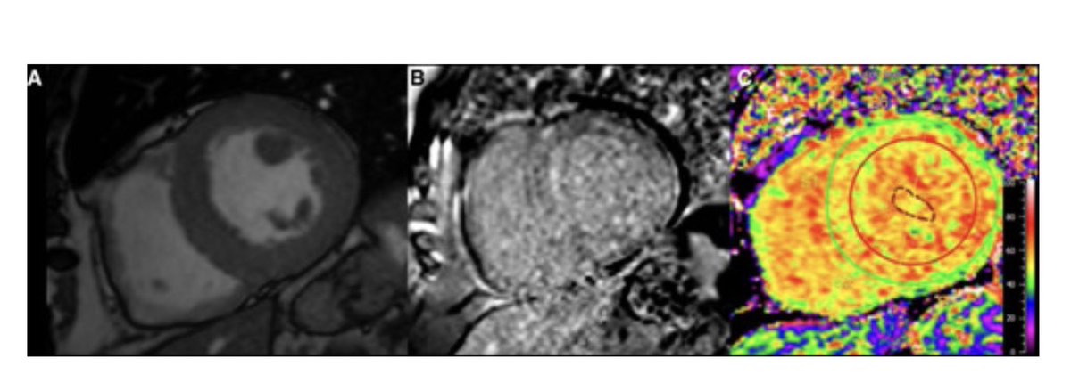 hvanspall's tweet photo. A comprehensive case-based review of the diagnostic workup of #CardiacAmyloid in @Circ_AHA 
https://t.co/fUxVAs3Ts0 
#ATTR #AL #Amyloidosis @DrClaudiusMahr @HeartOTXHeartMD @DrRajivsankar https://t.co/zrOFWhrxZd