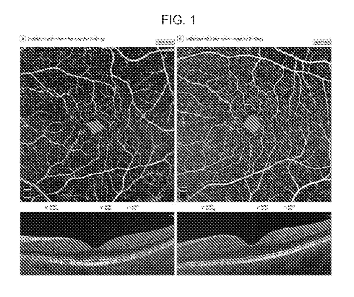 WashUOTM's tweet photo. Could we detect #Alzheimers with an eye test? WashU innovators developed a new, rapid, non-invasive screening method: https://t.co/fAMaeYaEp1 https://t.co/pPtCyM56JM