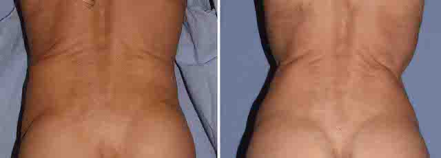 The debate is whether a portion of rib  #10 should also be removed in addition to ribs  #11 &  #12.  #10 is not a free floater & has a more horizontal orientation, which wraps around the waistline to attach to the subcostal rib cage. This is best for those who have a shorter torso