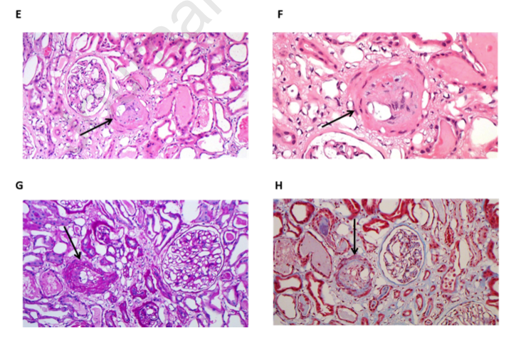 Kidney Medicine (@kidneymed) on Twitter photo Transplant-Associated Thrombotic Microangiopathy in a Patient With Polycystic Kidney Disease Immediately Post–Kidney Transplant: A Case Report
buff.ly/3kgAqoD #OpenAccess
<a href="/niten24/">Nitender Goyal</a> @Gordon7Craig <a href="/TuftsMedicalCtr/">Tufts Medical Center</a> #kidneytransplant #PKD Transplant-Associated Thrombotic Microangiopathy in a Patient With Polycystic Kidney Disease Immediately Post–Kidney Transplant: A Case Report
buff.ly/3kgAqoD #OpenAccess
<a href="/niten24/">Nitender Goyal</a> @Gordon7Craig <a href="/TuftsMedicalCtr/">Tufts Medical Center</a> #kidneytransplant #PKD