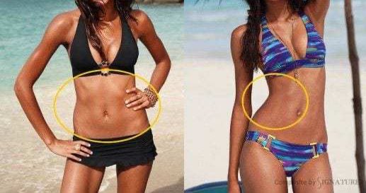 Rib Removal /Rib subluxation/ waistline narrowing A thread