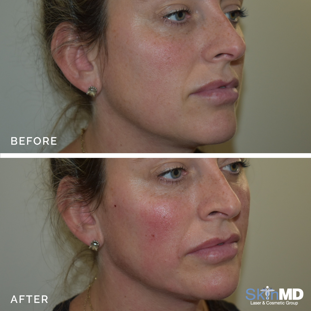 skinmdBOS's tweet photo. Sharing some filler magic! ✨💉
Only 1 Radiesse Plus and 2 Restylane Lyft! Great work by Dr. Shanley 😍

Book your consultation today to learn more! https://t.co/x2KubYStlN 
#Beforeandafter #SkinMD #Skincare #Injections https://t.co/fr95x5R3Lx