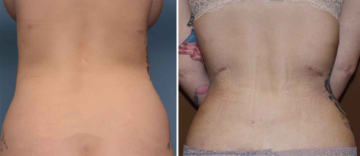 So how is exactly is it done? What is my scar going to look like? Aesthetic rib removal is done through a 4 to 4.5 cm long incision placed in an oblique skin fold seen when the patient turns at the waist.  This patient is 2 days post op