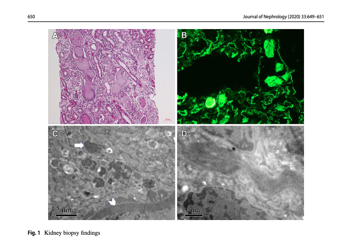 JournalofNeph's tweet photo. The interesting picture: simultaneous occurrence of myeloma cast nephropathy, light chain deposition disease and light chain proximal tubulopathy in a patient with multiple myeloma #myeloma #LCDD #LCPT https://t.co/Yy8y0vr9vV https://t.co/BQO9kcYmZj