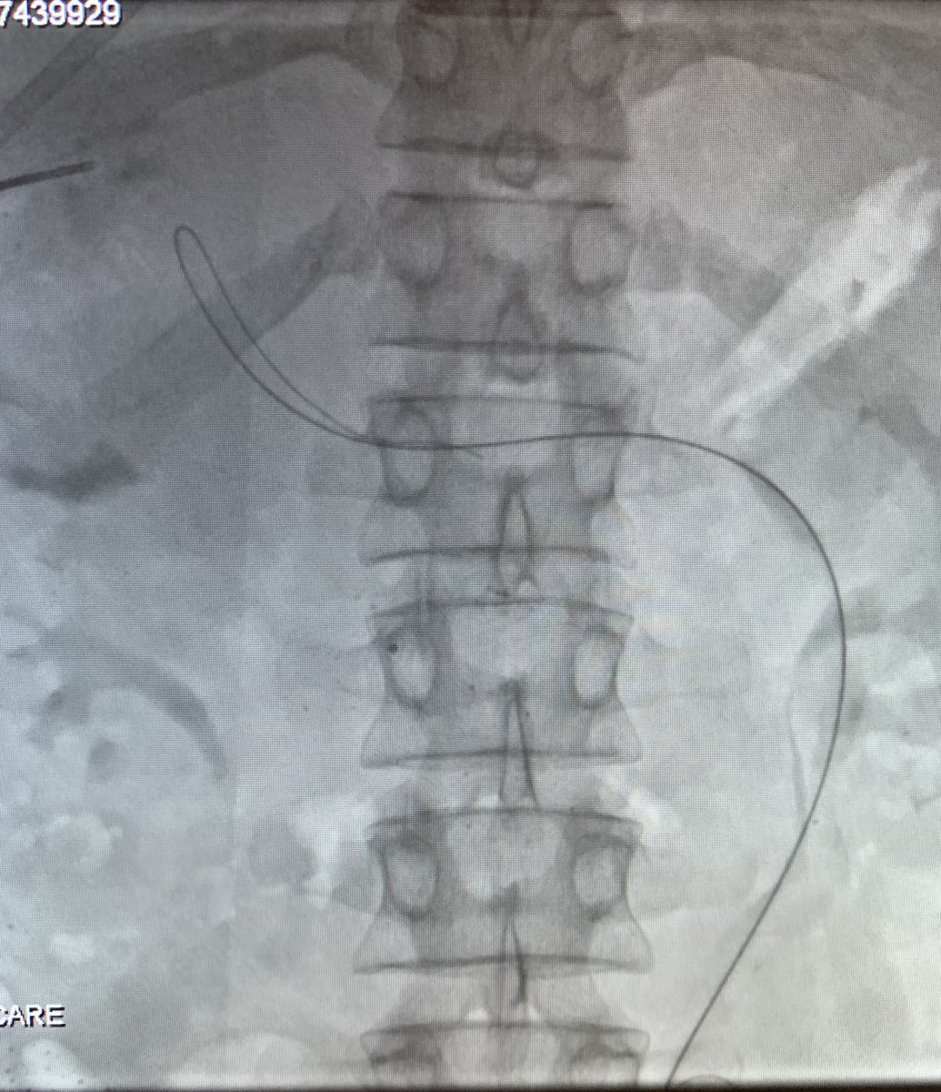 Next next evolution of PVR-TIPS: direct IMV puncture. JAK2 pt. No portal/SMV/Splenic vein on CT. @AASLDtweets @SIRspecialists @EASLnews @cirsesociety (1/2)