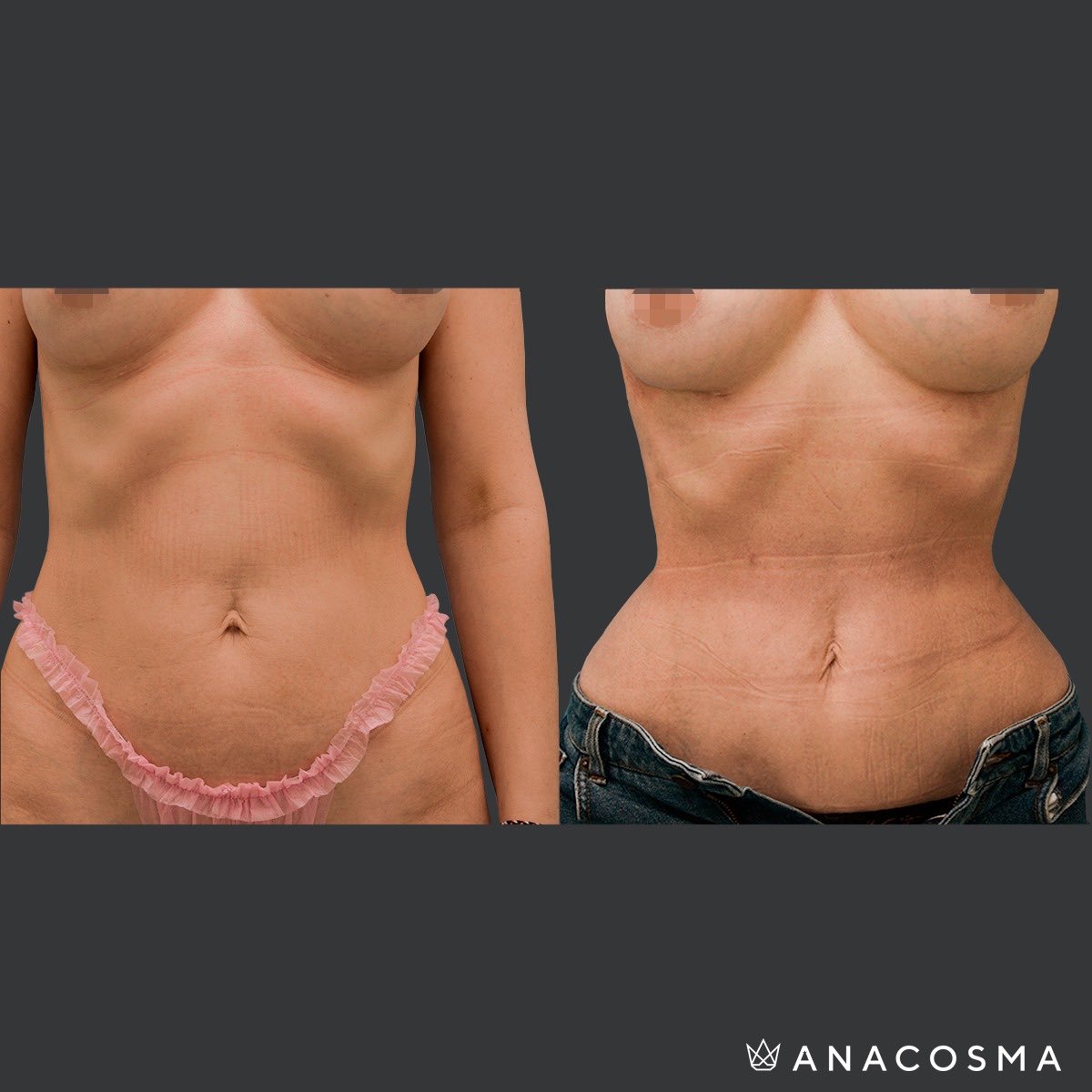 In the properly selected patient it offers an amount of waistline reduction that can not otherwise be achieved.