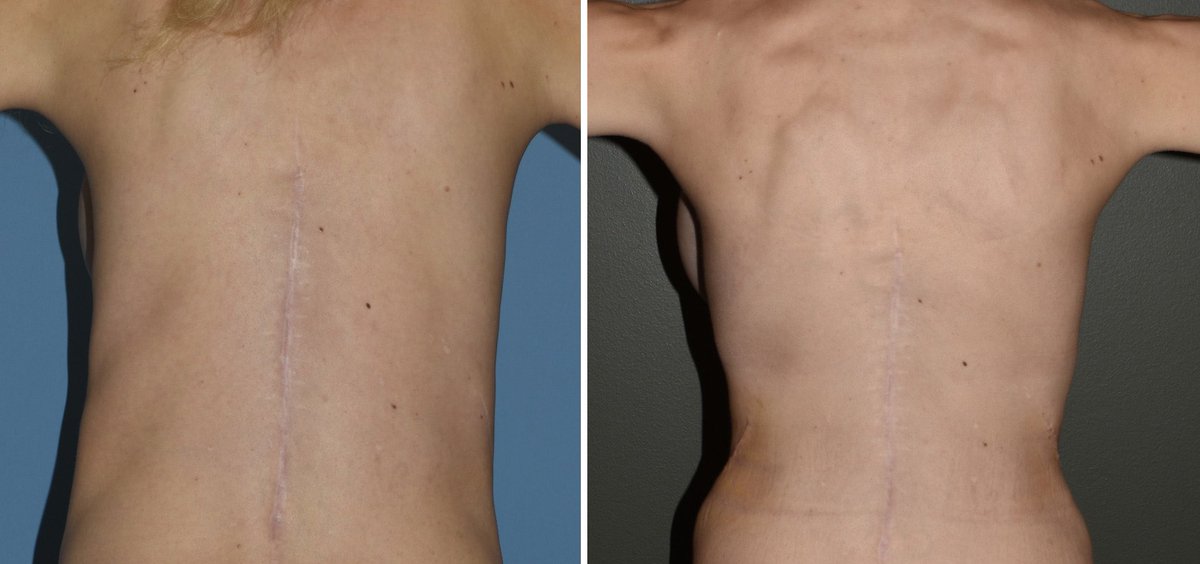 In the properly selected patient it offers an amount of waistline reduction that can not otherwise be achieved.
