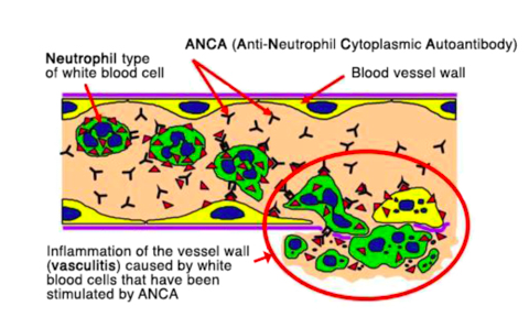 But wait, she's ANCA negative, we hear you cry! Yes, EGPA is ANCA-associated but only 30-70% patients are ANCA positive.  https://www.vasculitis.org.uk/about-vasculitis/what-is-anca  #RespEd  #RheumEd  #vasculitis 10/n