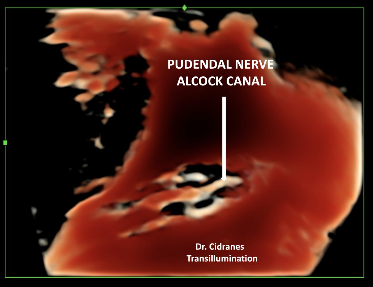 USAnesthesia's tweet image. Pudendal Nerve / Alcock Canal 
TRANSILLUMINATION Protocol 
PudendalEntrapment ? Yes or not ?? 
#pocus #advancedultrasound #madrid #pudendalnerve #madrid #spain #drcidranes #transillumination