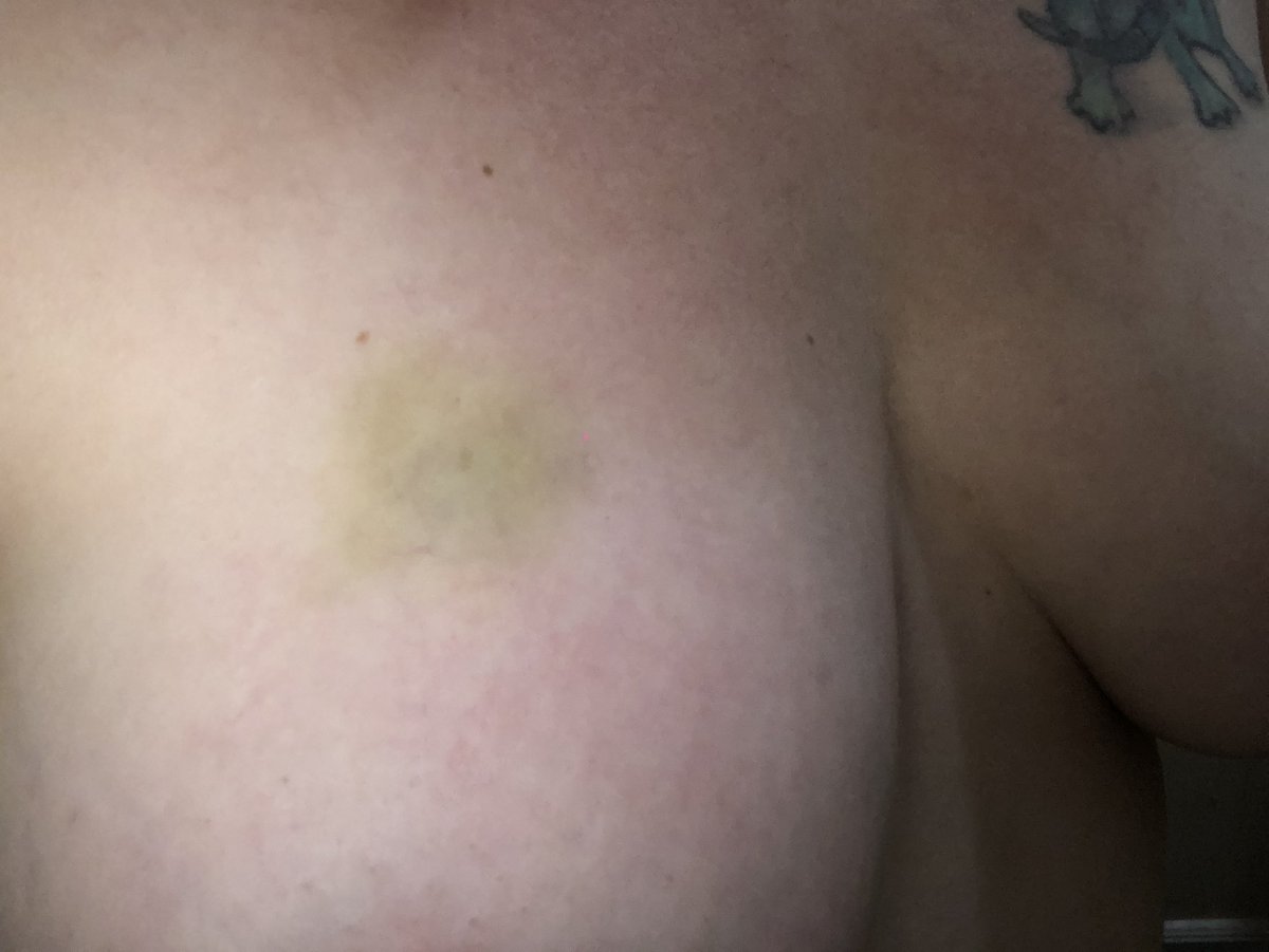 badgirlraylene's tweet photo. Bruises 😍                                        Sexy milf in her 30s 
🍑Nudes, 5’4, 175 lbs, 38C,
💦Squirting videos
🍆Anal Slut 
🔥Daily Posts and Videos
💋Kink Friendly
👅Sexting Available 
🤑Only $5 a month
https://t.co/uqjt8VjnlT https://t.co/e94kmcAUMt