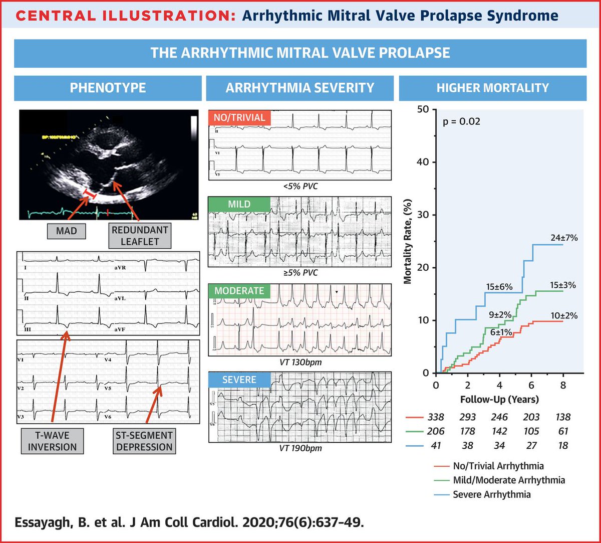 Mitral valve prolapse (MVP) is considered benign but a recent suggestion of an arrhythmic form raises doubt. A new #JACC study determined ventricular arrhythmia prevalence, severity, phenotypical context, &amp; independent impact on outcome in patients w/ MVP. bit.ly/2DCHTgV