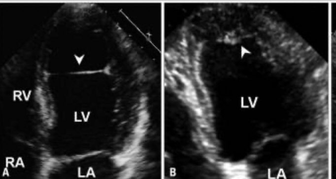 #EchoBoardPrep #ACCFIT 

Anatomic Variants

But 1st, RA anatomy:
⚡️Eustachian valve: IVC valve 
⚡️Th...