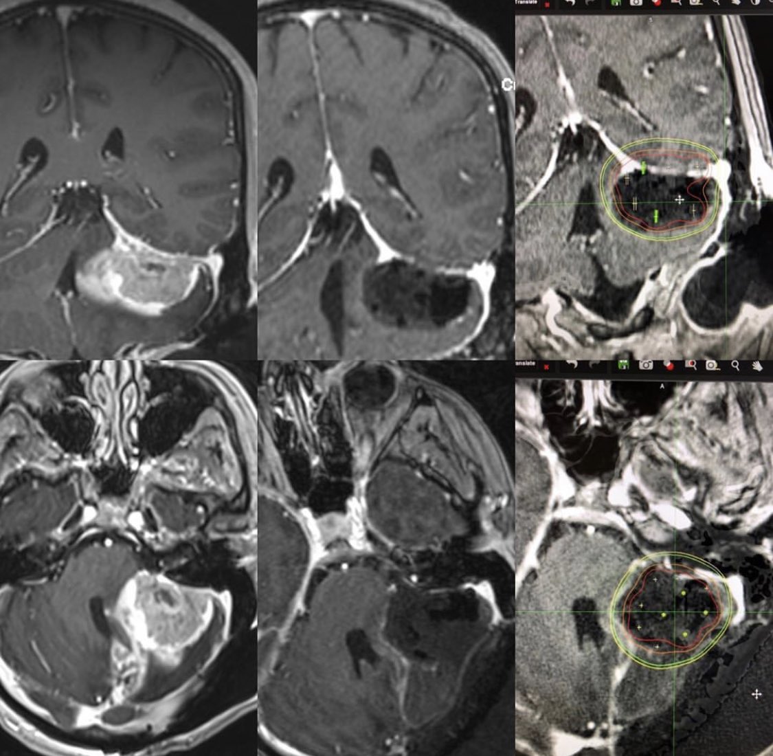 D. Jay McCracken, MD, FAANS (@djmccrackennsgy) on Twitter photo A day in the life of a neurosurgeon in pictures only. Thanks for the nomination <a href="/jnbmd/">Nicole Bentley</a> #gammatile A day in the life of a neurosurgeon in pictures only. Thanks for the nomination <a href="/jnbmd/">Nicole Bentley</a> #gammatile
