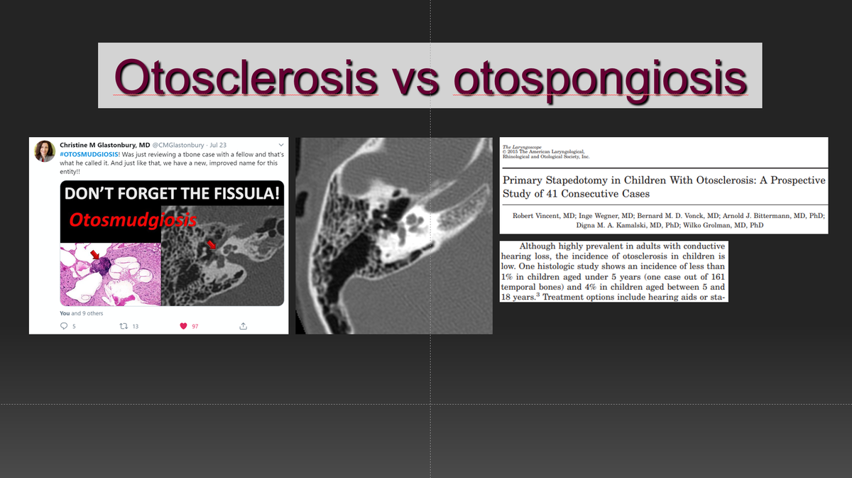 callyrobs's tweet photo. @ashasarm @amyfjuliano @FeliceDArco @gmoonis @stanford1891 @ASHNRSociety @CMGlastonbury To give credit where due for coining the term #otosmudgiosis @CMGlastonbury and @ the anon fellow! Not something we see often in kids, therefore more likely to overlook as a cause of conductive hearing loss. Wikipedia had plenty to say about "otosclerosis" being a misnomer. https://t.co/FDwMkkLdcH