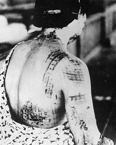 l: dd: Hibakuša: přeživší dopadu atomové bomby v Hirošimě. Žena utrpěla těžké popáleniny, vzory na její kůži jsou z kimona, které měla oblečené při výbuchu.