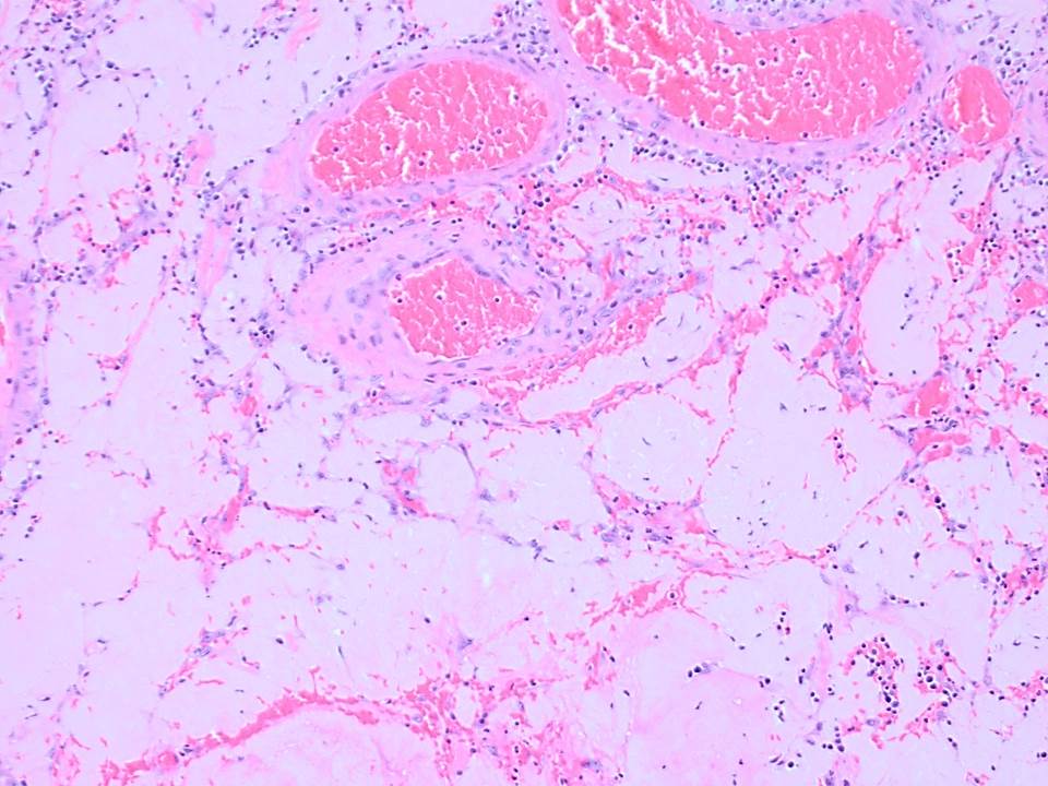 RunjanChetty's tweet photo. I have waited a long time for this case to cross my microscope!! Others have seen it and now I join the club!!
A recalcitrant polyp that caused the endoscopist to abandon the polypectomy and resort to an EMR. https://t.co/30MIb3p4pC