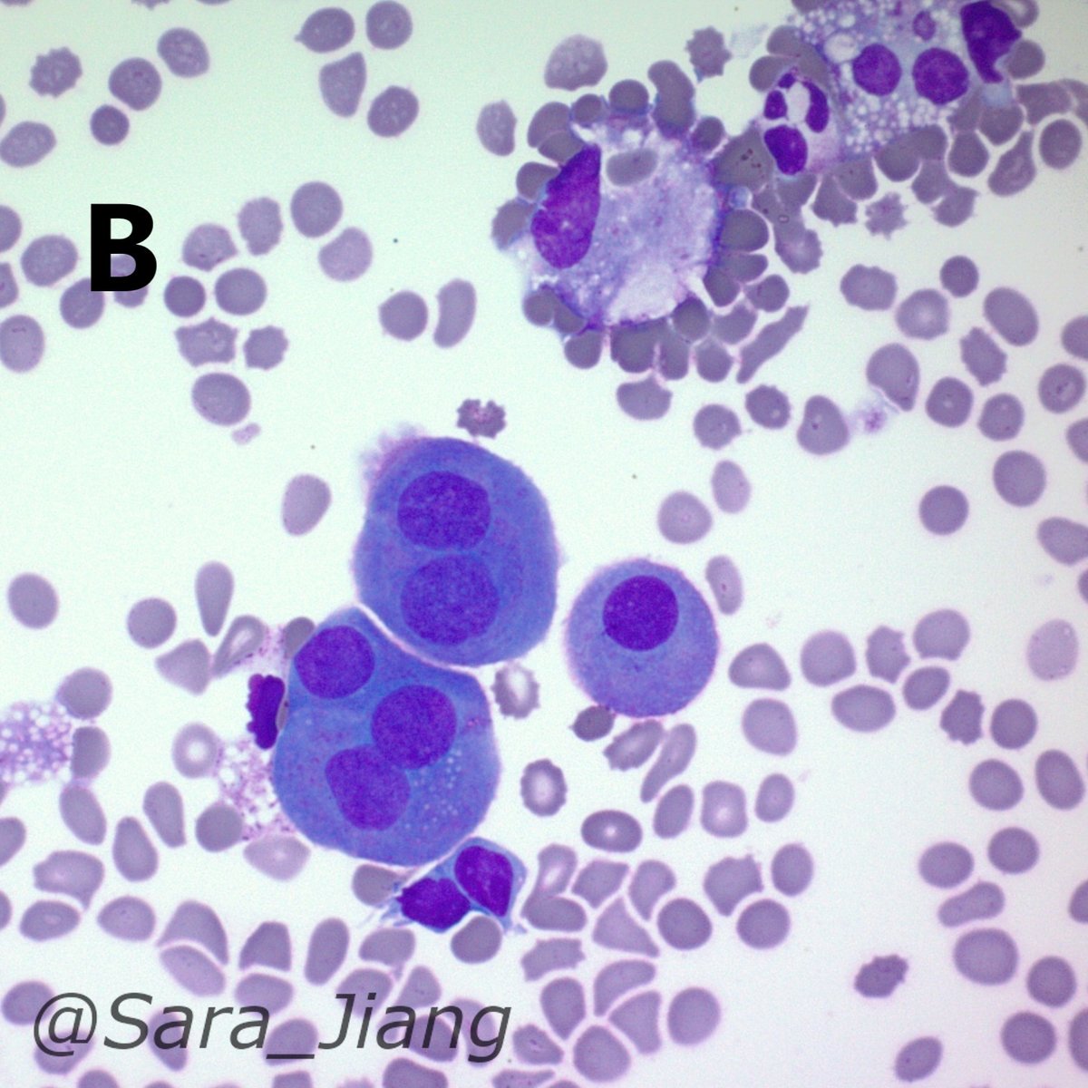 #CytoABCs!
V is for Vacuoles, large or small, seen in cytoplasm of various cells.
While vacuoles are often associated with adenocarcinomas (A), you can see vacuoles in everything from the umbrella cells of U to benign mesothelial cells and histiocytes (both present in B).