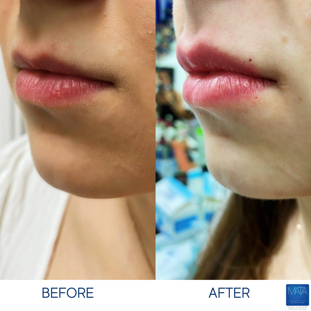 MATACourses's tweet photo. Beautiful results from a lip enhancement done by our MATA trainer, Dr. Semira Kwabi. Level up your practical skills with a lip masterclass!

For more information on our training; 

 contact@matacourses.com 

 020 3976 6979

#lipfiller #dermalfillertraining #aestheticstraining https://t.co/b6Pcc85mTm