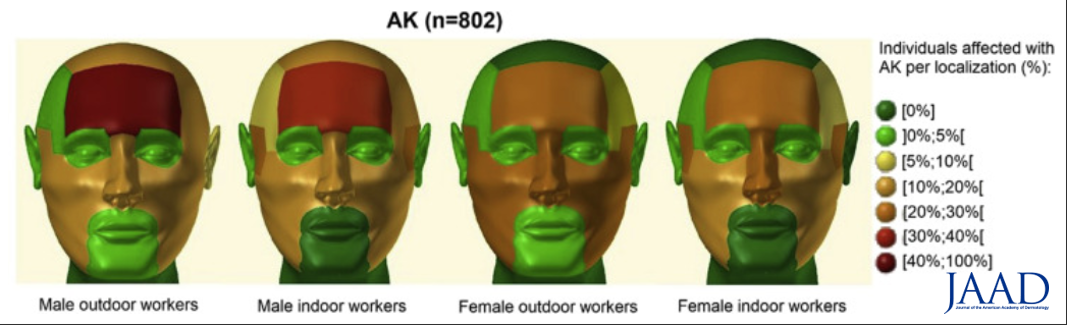 High-risk body sites for actinic keratosis in outdoor and indoor workers: A retrospective review bit.ly/33wR3XA