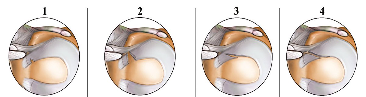 #savethemeniscus  LMORT: A Classification System Based on Arthroscopic Tear Patterns in 600 Consecutive Patients Orthop J Sports Med. 2020 May; 8(5)
