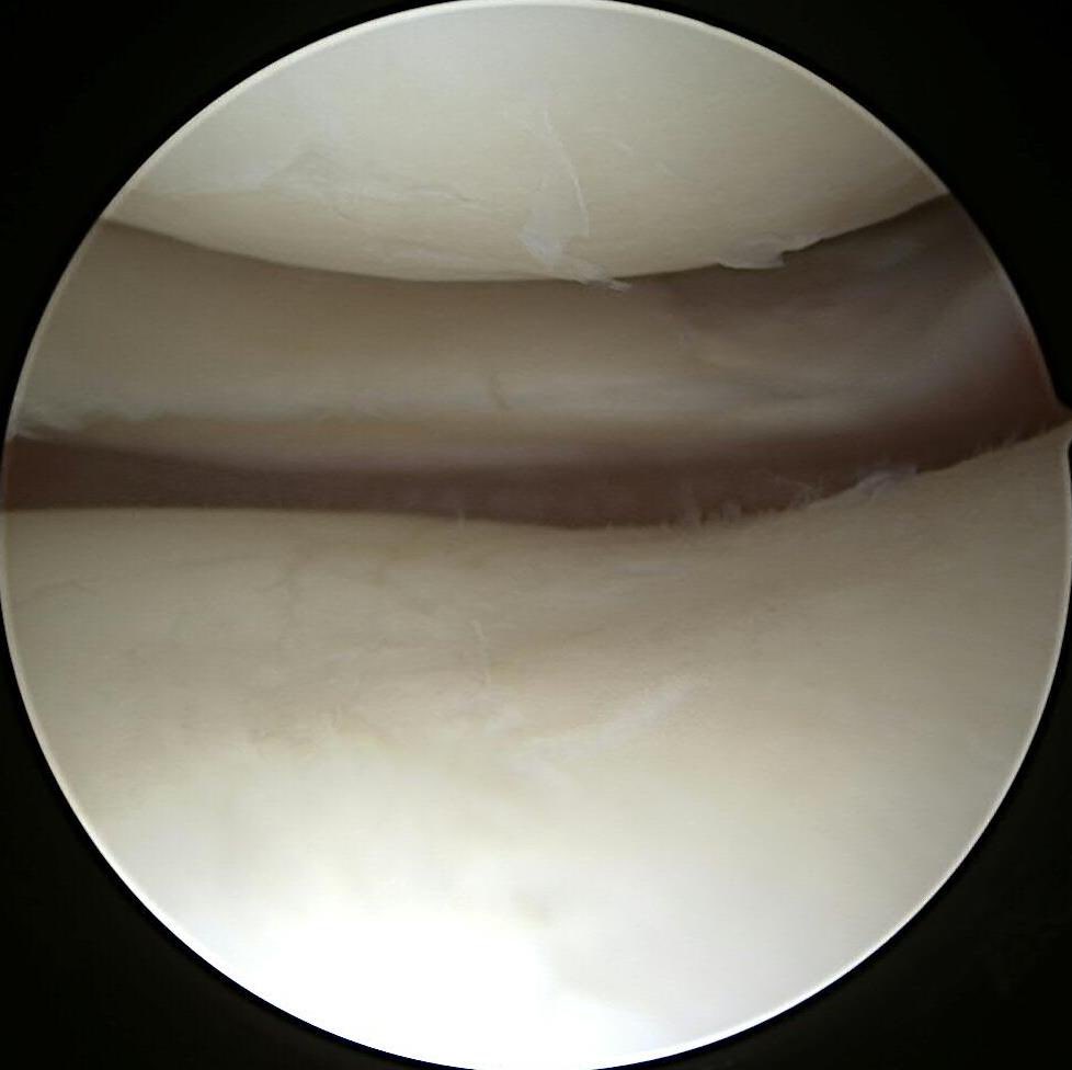 #savethemeniscus LMORT all-inside repair with 2nd look arthroscopy