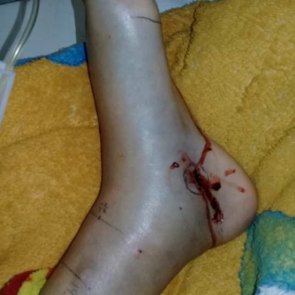 ReporteYa's tweet photo. #6Ago #ServicioPúblico #Táchira
En emergencia del Hospital Central se encuentra una niña de 12 años, que la mordió una serpiente.

Su familia no tiene para comprar el antiofídico.
Están desesperados porque no tienen el dinero.
0424-7204304
Sra. Keila Velásquez - @LaPrensaTachira https://t.co/FdKM8zOdmO