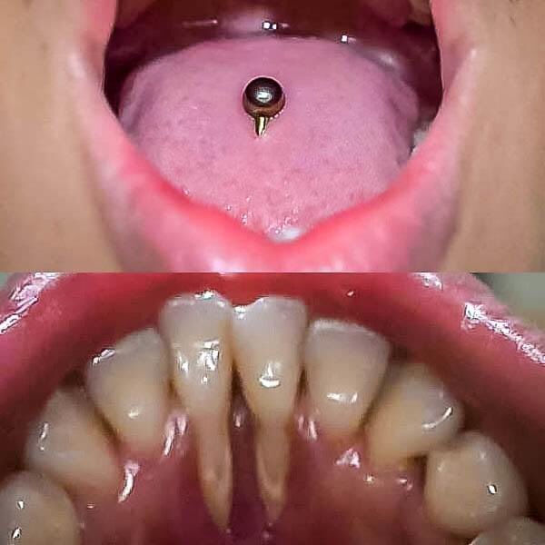 Tongue Piercing Keloid