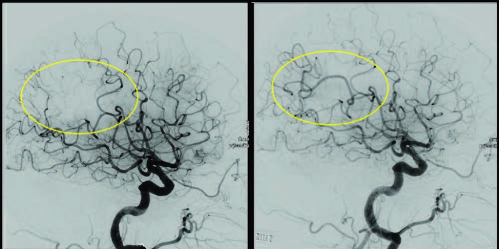 SPECIAL REPORT: Thrombectomy for Distal, Medium Vessel Occlusions: A Consensus Statement on Present Knowledge and Promising Directions #stroke <a href="/dliebesk/">David S Liebeskind, MD, MBA</a> <a href="/AshuPJadhav/">AshuJadhav</a> ow.ly/DNUB50ASvlI