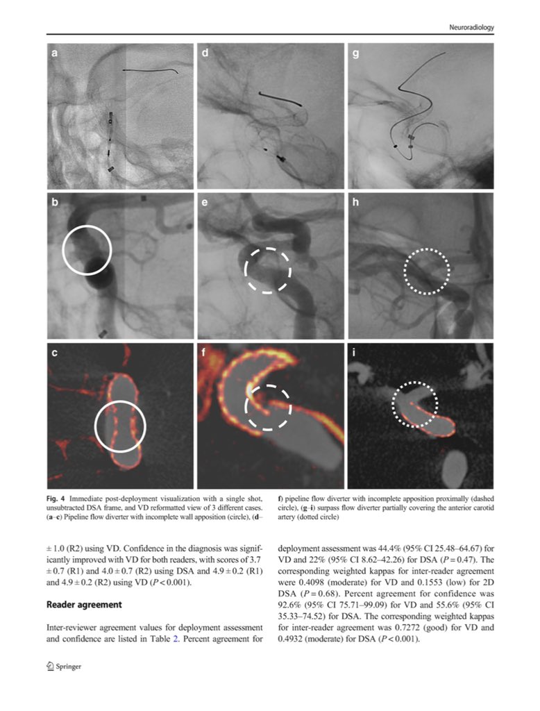 AmeerEHassan's tweet photo. #VesselAssist Seeing is believing, was interesting to see the number of times flow diverters were not well positioned. https://t.co/POmUzxVhrW @wondeasa @svinsociety @SNISinfo @esmintsociety @LINNConline @PairsNeuro @YoungNIR @Medtronic @Stryker_NV @GEHealthcare https://t.co/fQwCAU4HYD