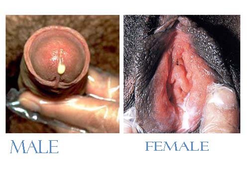 gonorrhea in female gonorrhea in female