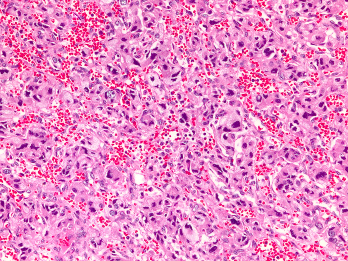 S-100. There's one other stain you should perform to rule out a particular syndrome, but first...please name another neural crest tumor from the adrenal gland.