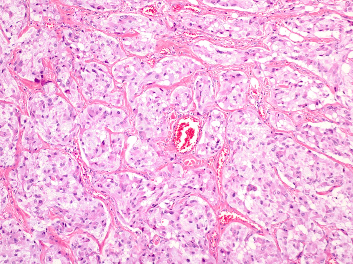 Name the following tumor of neural crest origin: