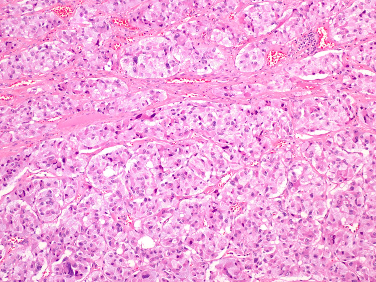 Name the following tumor of neural crest origin:
