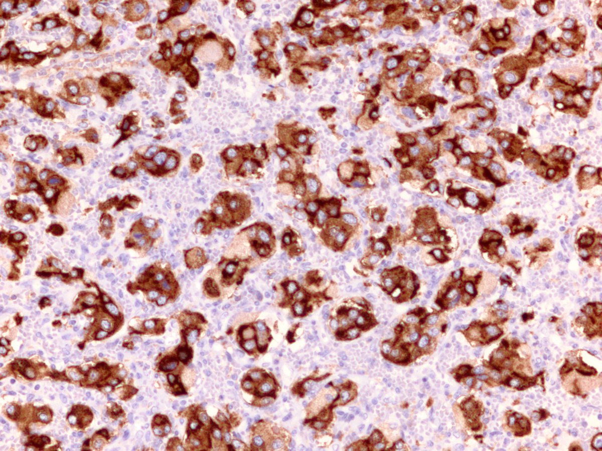 Pheochromocytoma. Below are the chromo and synapto stains for your viewing pleasure.