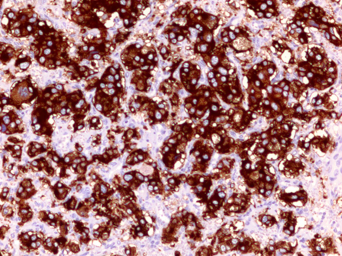 Pheochromocytoma. Below are the chromo and synapto stains for your viewing pleasure.