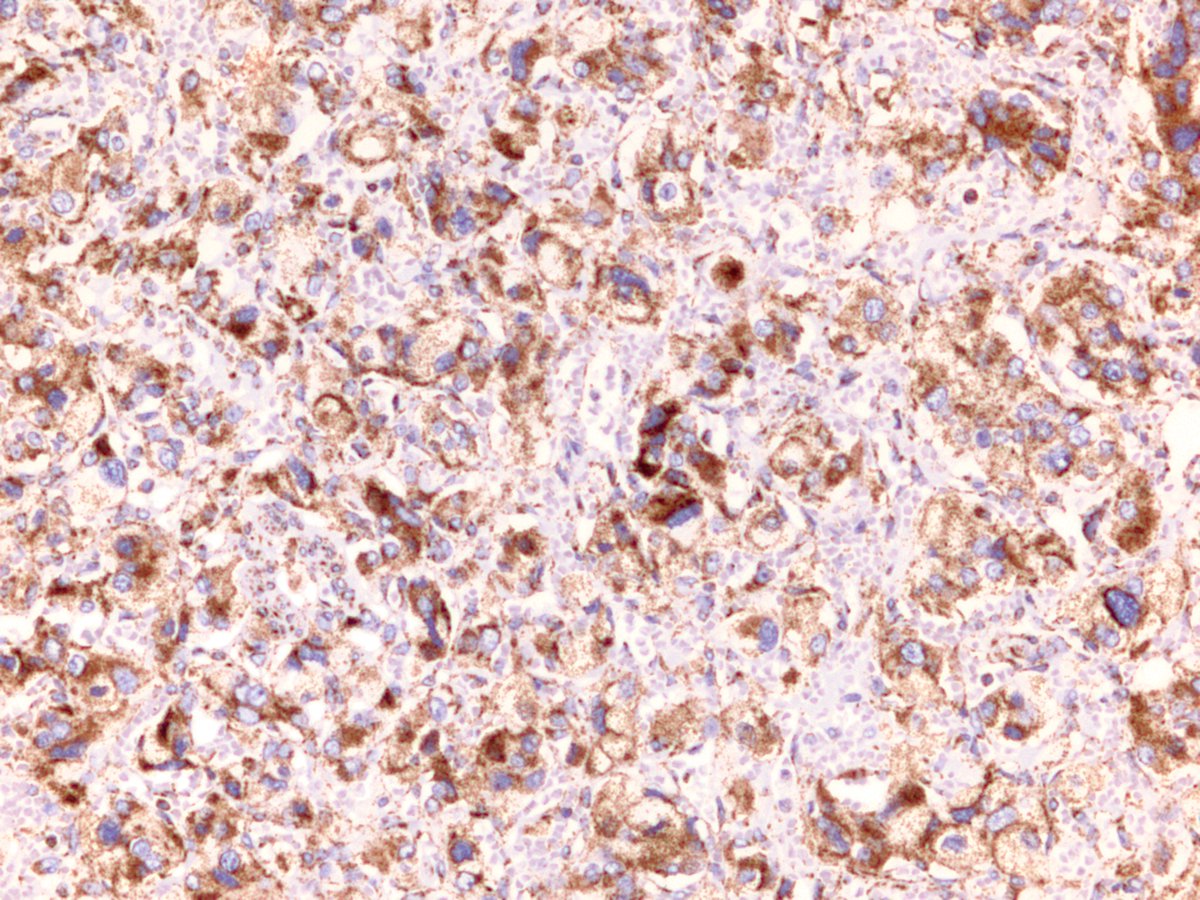 Succinate dehydrogenase (SDH): a mitochondrial enzyme that converts succinate to fumarate -- Krebs cycle PTSD, anyone? Note that PGL/Pheo syndrome can also arise in the setting of VHL, MEN2, NF1 mutations. Below is our SDH stain, which should be lost in syndromic patients.