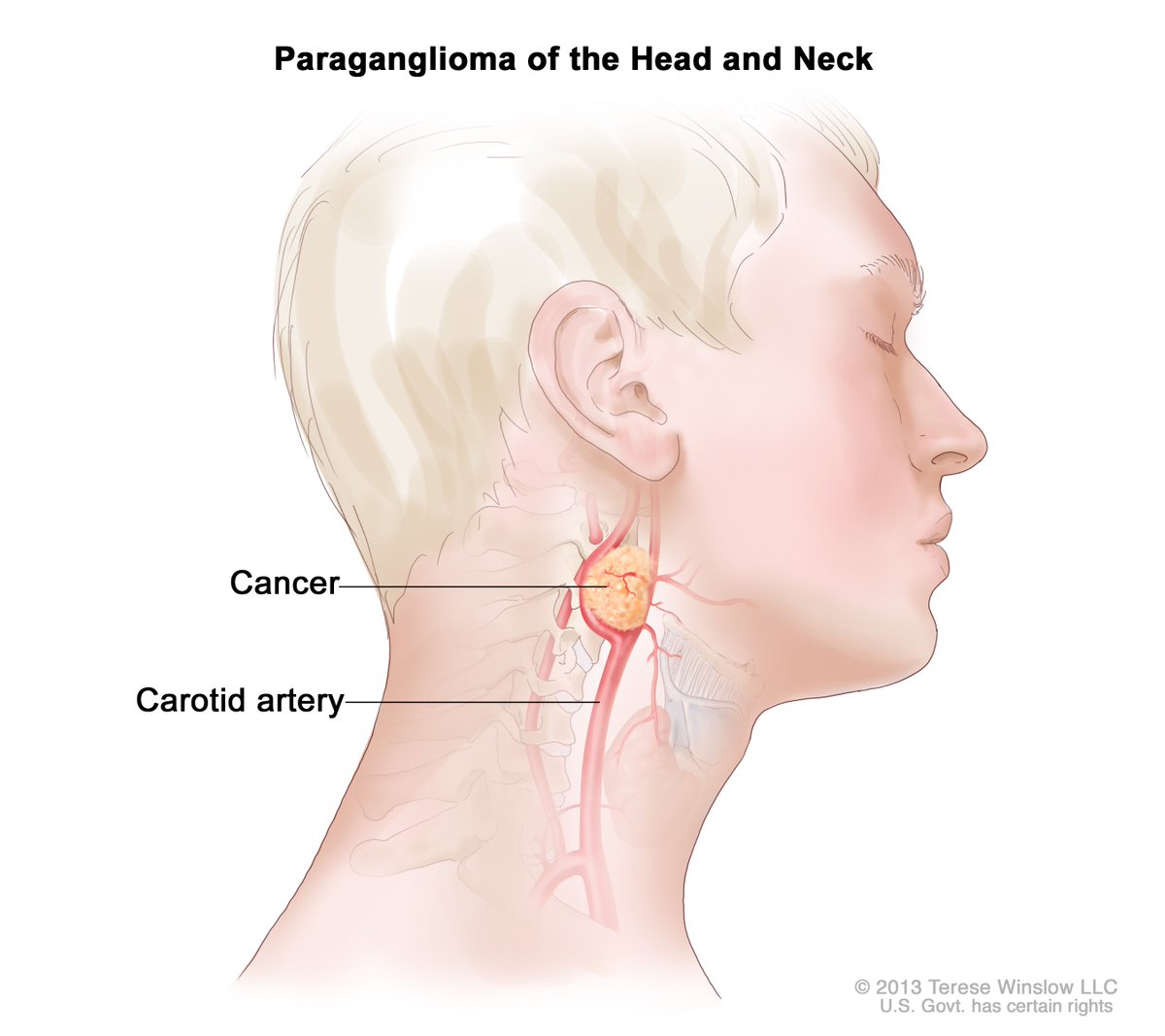 Study by @RoswellPark says patients receiving #radiotherapy for head and neck cancers and are hospitalized for dehydration and fever are at higher risk of death from these complications as reported by @CancerNetwrk: bit.ly/33u3NOy #CancerResearch