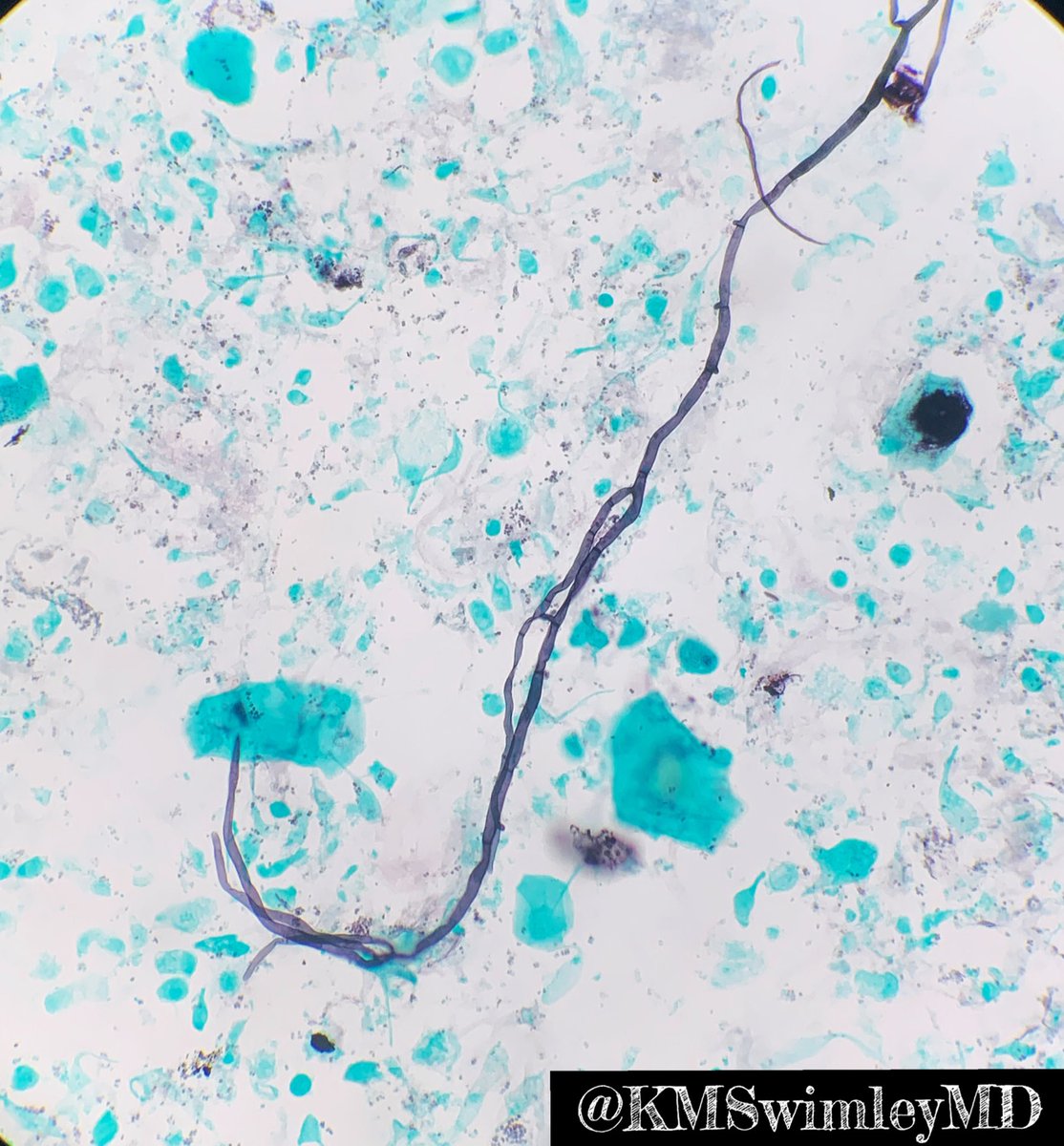 Interesting case: Bronchial washing of a middle aged male with acute respiratory failure. Any guesses as to what this critter was identified as? First pic: ThinPrep Second pic: GMS special stain. #Cytopath #cytopathology #pathtwitter #microbiology