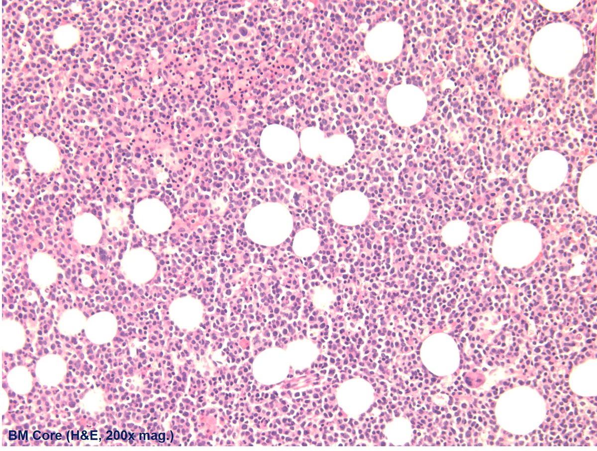WVUHemePath's tweet photo. #MarrowMonday with a #FlowMo correlation... 55M with pancytopenia, including absolute neutropenia & lymphopenia.
Bone marrow aspirate, core biopsy, and selected IHCs to follow. Thoughts? Questions? Dx?
Case Credit: @docmauten https://t.co/ybN2aXDLZ3
