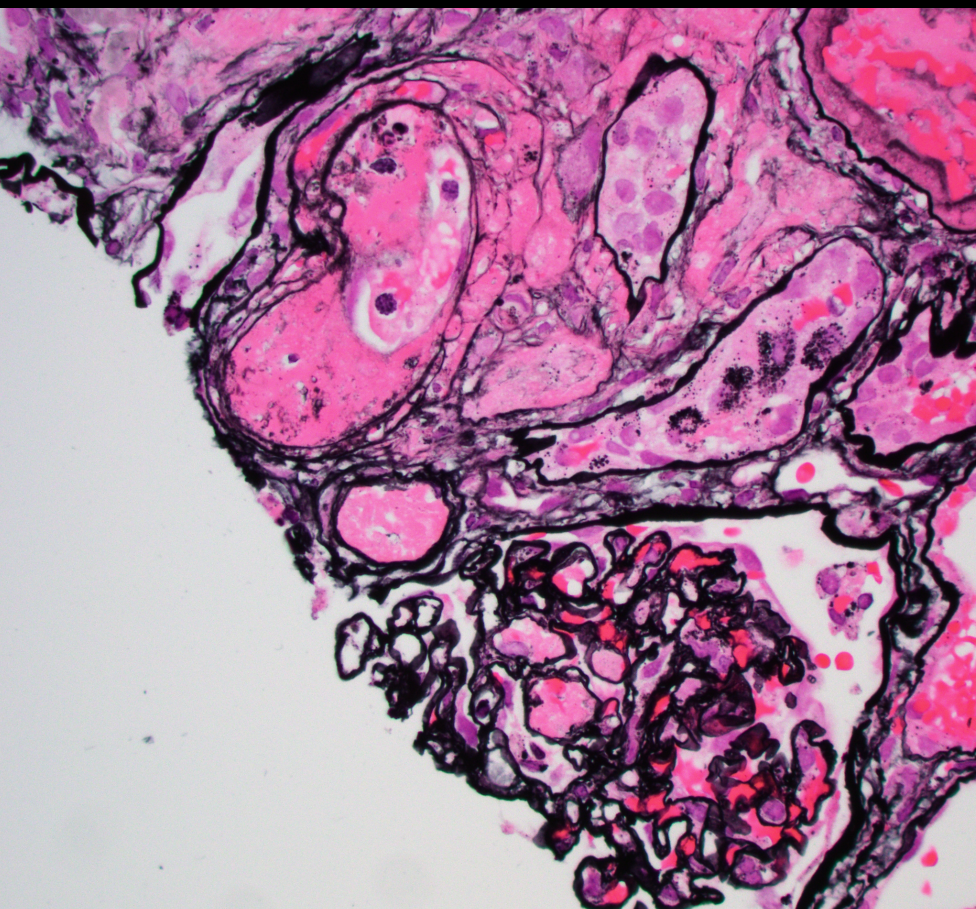 JZRenalPath's tweet photo. Terrible TMA. SLE patient with bloody diarrhea and AKI. Also some membranous lupus nephritis in the mix b/c one dx is never enough in #renalpath. IF is C1q. https://t.co/wXGbUnAl1v