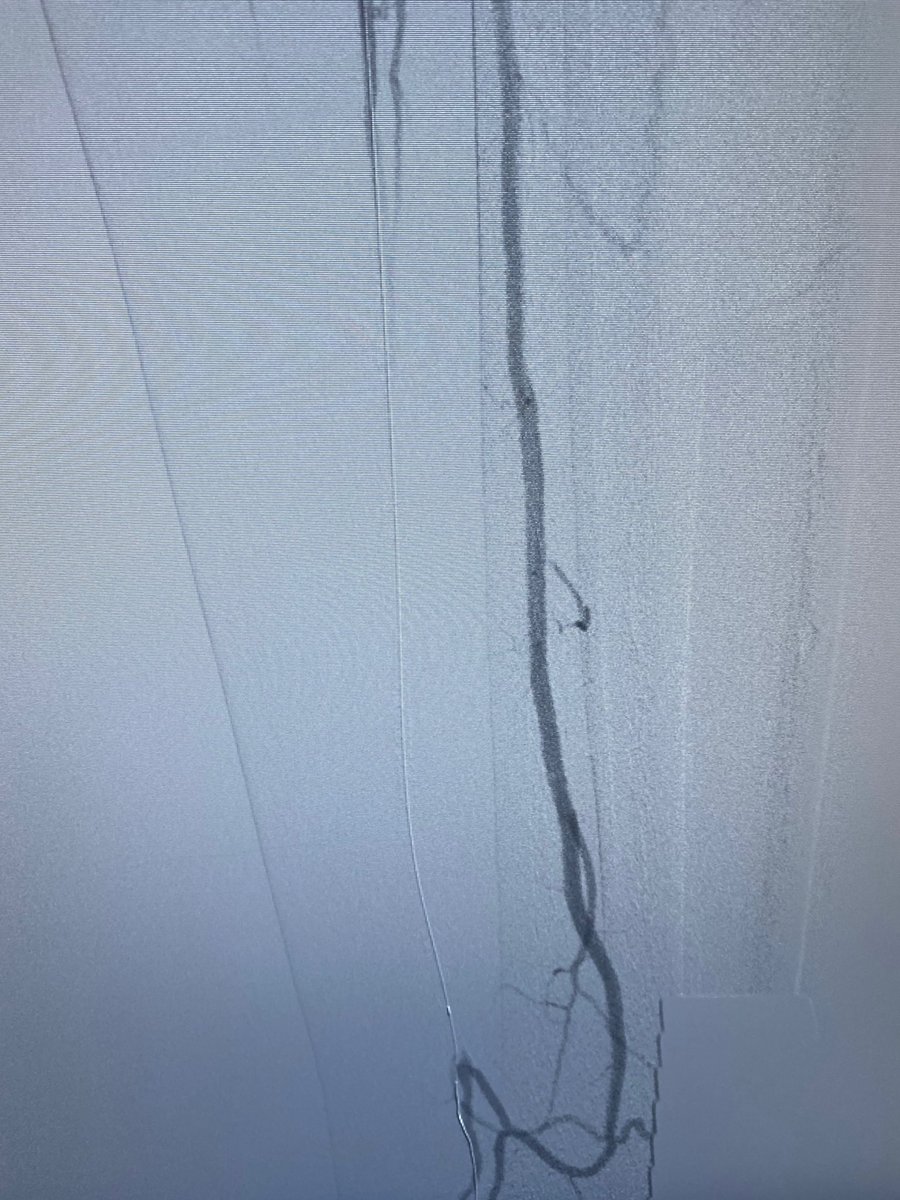 drachylegs's tweet photo. CTO PT with atherectomy and angioplasty with ivus noting dissection and no flow sealed with three tacs. Great result post tac deployment. #cli #amputationprevention #intactvascular #noamputation #pulsephysicians #thewoodlands #centerforcvexcellence #peripheralvasculardisease https://t.co/ix5BTKW9RP