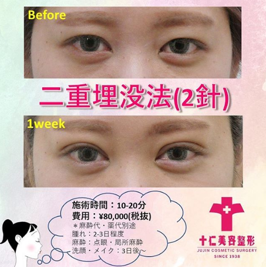 埋没法