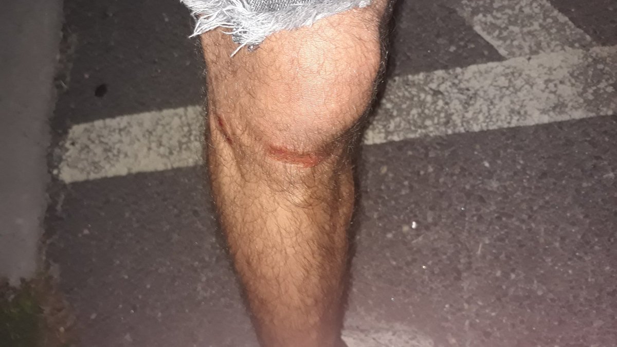  #RichmondProtest on 7/26: An image shows a injury to his knee. He states that a magistrate said there was no probable cause for his arrest and released the protester without charges. (angle 2/2)[ @GoadGatsby]