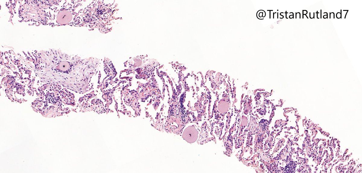 Older patient, lung mass. @ZHOUSEH  @MattieFarzin  @smlungpathguy  @quadrellis  #pulmpath  #liverpoolpath  #aussiepath  #surgpath  #PathTwitter