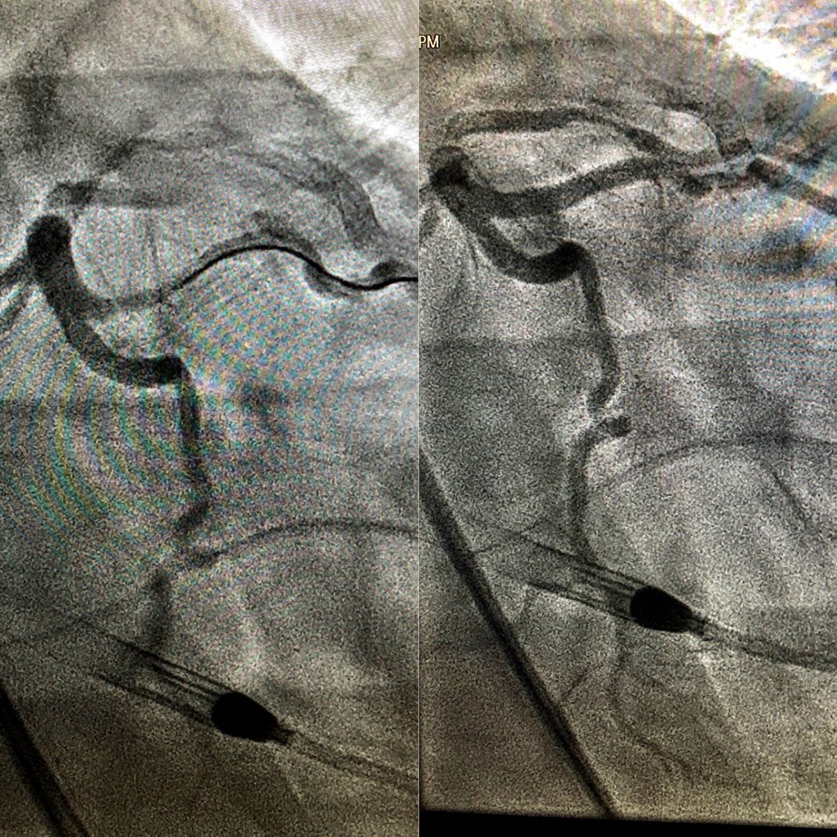 DrTomWaggoner's tweet image. 7Fr AL-1 guide, 7Fr guideliner, Rota extra support through a Corsair and still struggled with wire support. #how many catheters-inside-catheters does it take? #HRPCI #SingleAccess
#balancedischemia #pimaheartandvascular #tmcstructuralheart
