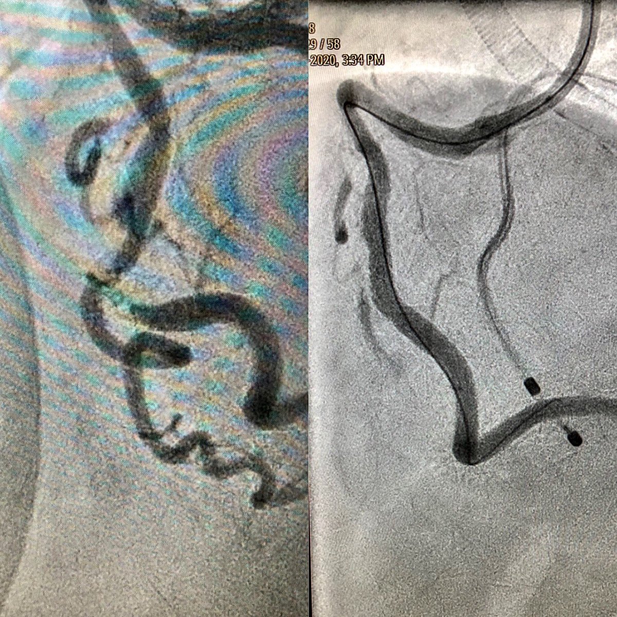 DrTomWaggoner's tweet image. 7Fr AL-1 guide, 7Fr guideliner, Rota extra support through a Corsair and still struggled with wire support. #how many catheters-inside-catheters does it take? #HRPCI #SingleAccess
#balancedischemia #pimaheartandvascular #tmcstructuralheart