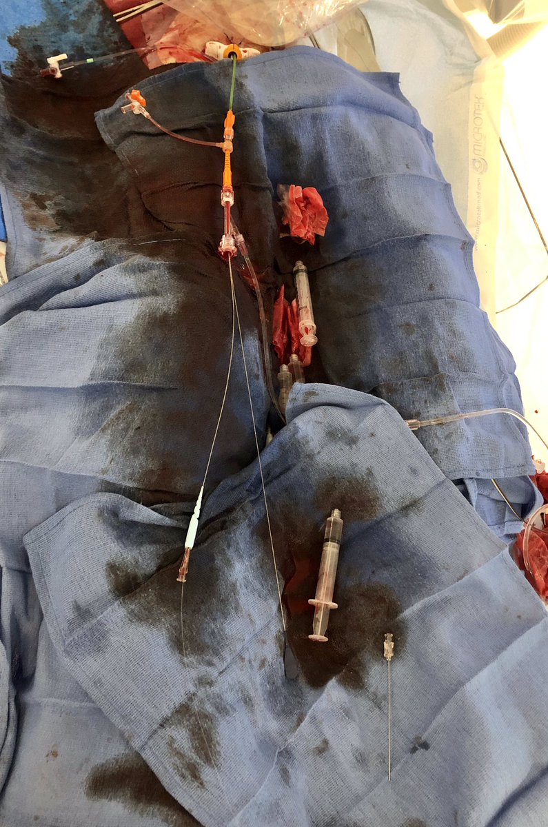 DrTomWaggoner's tweet image. 7Fr AL-1 guide, 7Fr guideliner, Rota extra support through a Corsair and still struggled with wire support. #how many catheters-inside-catheters does it take? #HRPCI #SingleAccess
#balancedischemia #pimaheartandvascular #tmcstructuralheart