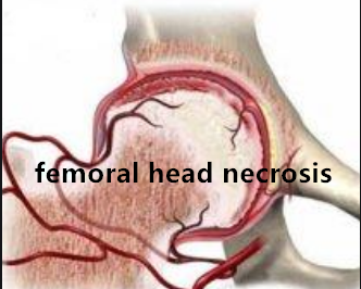 ctdd_stm's tweet photo. #CTDD [Study Protocol] Transcription factor Runx2 in necrotic femoral head tissue: study protocol for a retrospective non-randomized parallel-controlled trial
#femoralheadnecrosis #osteoarthritis

https://t.co/olXrMnIESk https://t.co/CAtDKgpGA4
