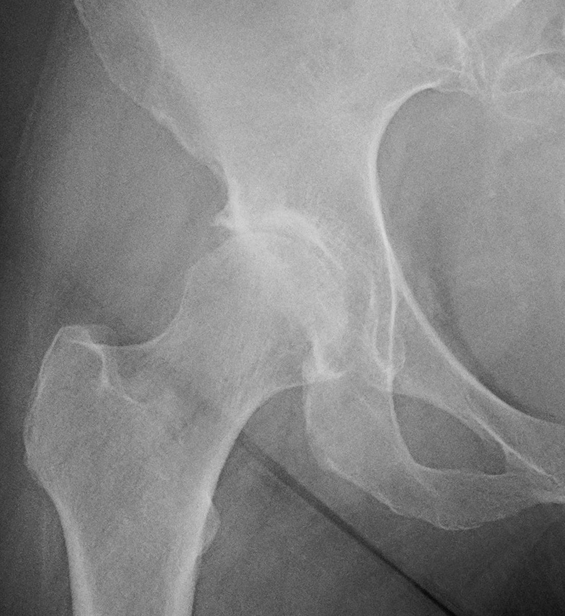DrDerekOchiai's tweet photo. I posted a patient based situation where she had only knee pain. In this setting, the knee pain was referred pain from the hip joint, from hip arthritis. To all medical providers, if a patient presents with knee pain, please also examine the hip joint. #MedTwitter https://t.co/VvtH9CDCas