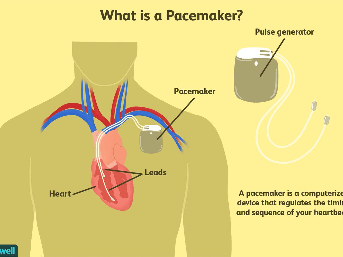 Eng_Bandar9's tweet photo. 💡#معلومات على السريع:
🔸 جهاز #pacemaker:
يساعد ويدعم في أداء وظائف القلب وكذك التحكم في إيقاعات القلب
🔸 جهاز #patient_Monitor:
يوفر معلومات لمراقبة الحالة الصحية للمريض من خلال وظائف مختلفة من خلال شاشة مراقبة تمكن الطبيب من إتخاذ القرار بشكل مثالي
#بندر_الشبلاني https://t.co/42ROf4jLnz